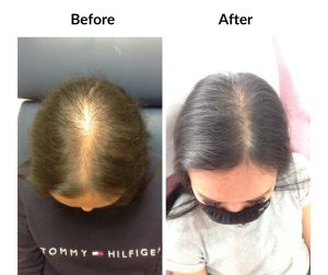 BEFORE AFTER - Female - Thinning 2