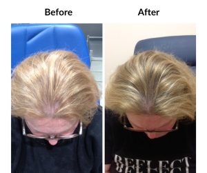 BEFORE AFTER - Female - Thinning 4