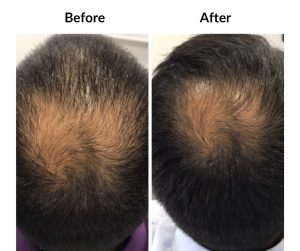 BEFORE AFTER - Male - Thinning and balding, same guy, 2