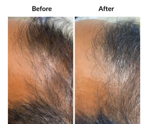 BEFORE AFTER - Male - Thinning and balding, same guy (2)