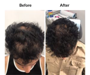 BEFORE AFTER - Male - Thinning and balding, same guy 3 (2)