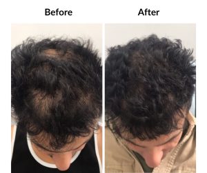 BEFORE AFTER - Male - Thinning and balding, same guy 3 (3)